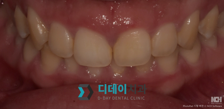 구강전정술 잘하는곳? 이 2가지 모르면 못찾습니다 관련 이미지 6