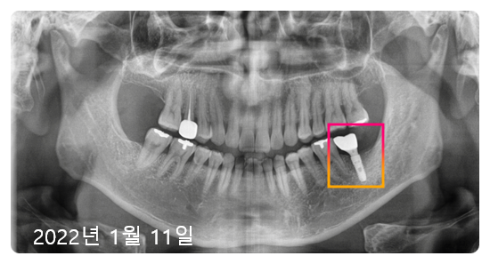 압구정 임플란트? 광고글 보다가 지친 분들만 <필독> 관련 이미지 7