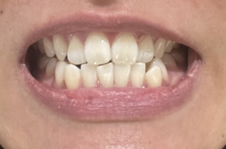 치과치아미백 #내돈내산 찐후기 (feat. 직원이 직접 받은 솔직후기) 관련 이미지 9