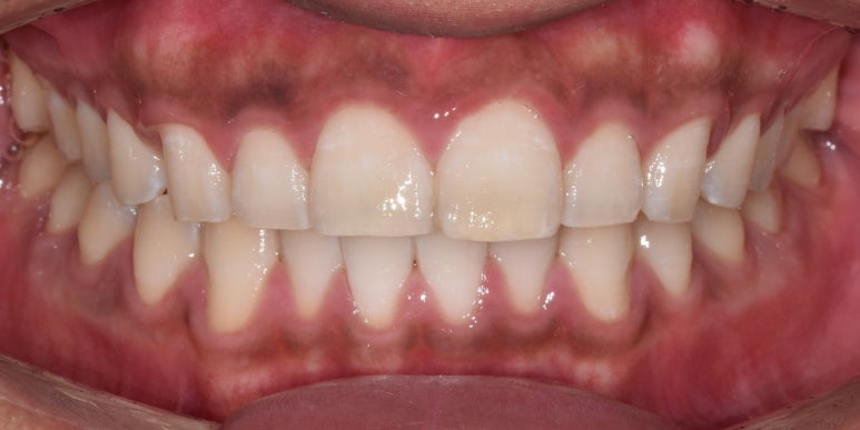 누렁니치아미백, 치료 사례로 보여드리는 개선 효과 관련 이미지 6