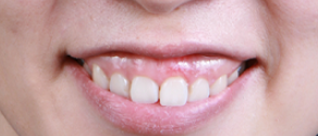 치은성형술, 잇몸이 너무 많이 보여서 웃기 싫었다면 의사 작성 관련 이미지 4