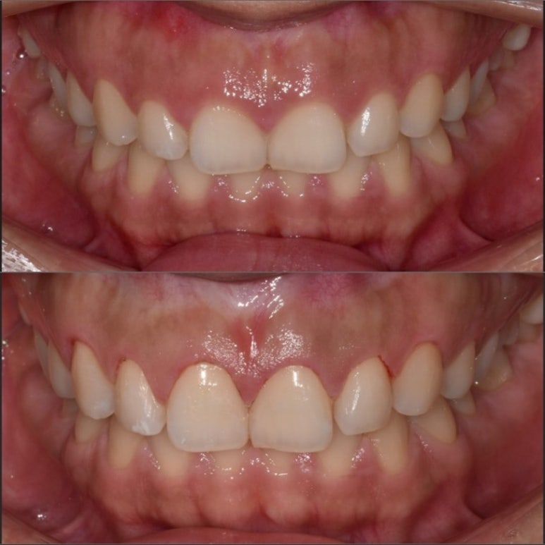 잇몸성형가격? 비용, 주의사항, 치료 후기 공개 관련 이미지 1