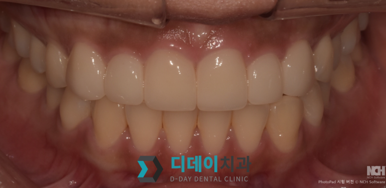 치아미백 라미네이트 잘하는 곳 찾는 2가지 기준 관련 이미지 9