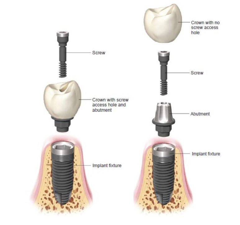 임플란트흔들림? 당황하지 말고 바로 해야할 일은? 관련 이미지 2
