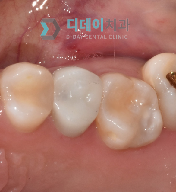 치과레진가격, 진솔하게 공개합니다. (+좋은치과 찾는 팁) 관련 이미지 6