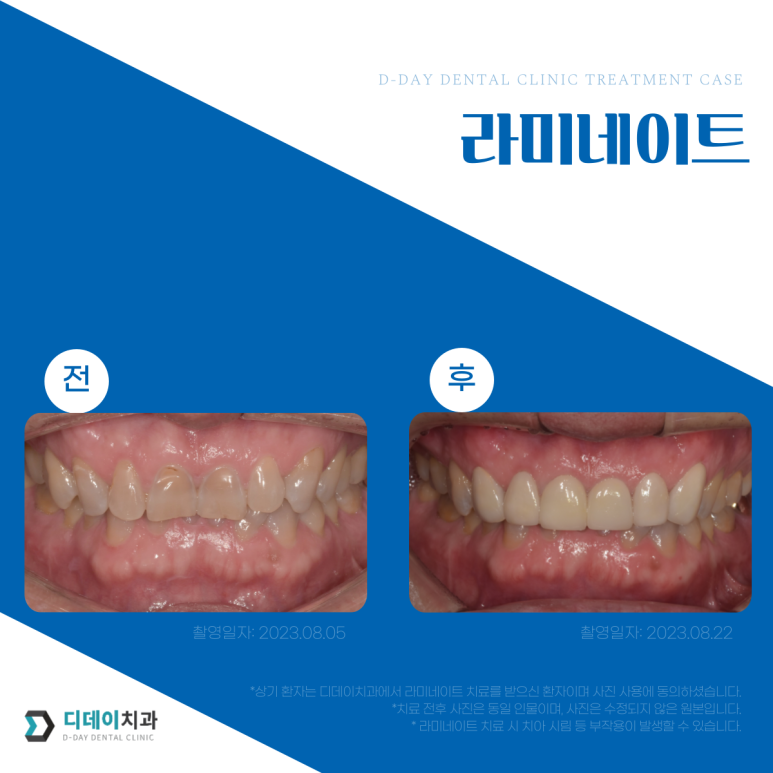 라미네이트비용 궁금하다면? 치과의사의 팩트체크! 관련 이미지 5