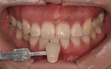 웨딩촬영치아미백? 자신있게, 환하게 웃을 수 있는 꿀팁 관련 이미지 6