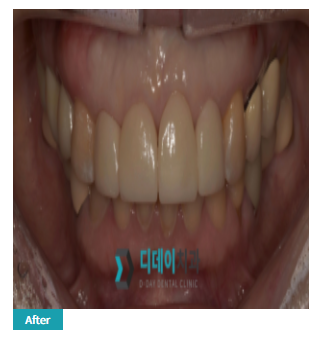 모델 라미네이트? 치과 어디서 받는게 좋을까요? 관련 이미지 4