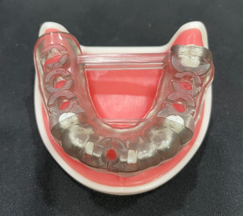 네비게이션임플란트, 무조건 성공하는 것은 아닌 이유? 관련 이미지 5