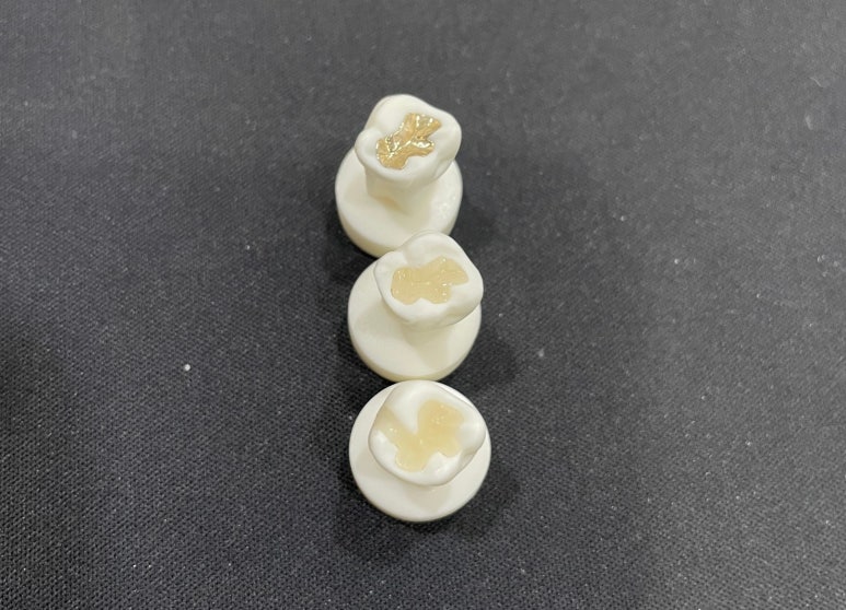 세라믹인레이가격만 보고 치과 결정하지 마세요 관련 이미지 3