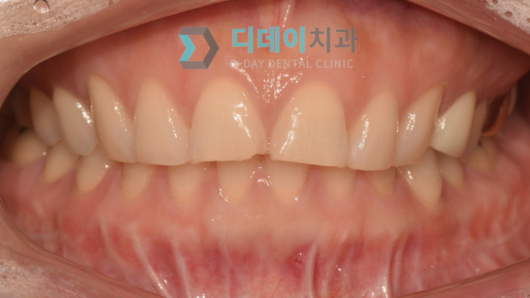 어금니가시려요, 원인별 해결법 의사가 알려드립니다 관련 이미지 5