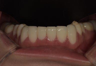 교정없이 라미네이트로 치아배열 개선? 앞니 12개 케이스 공개 관련 이미지 10