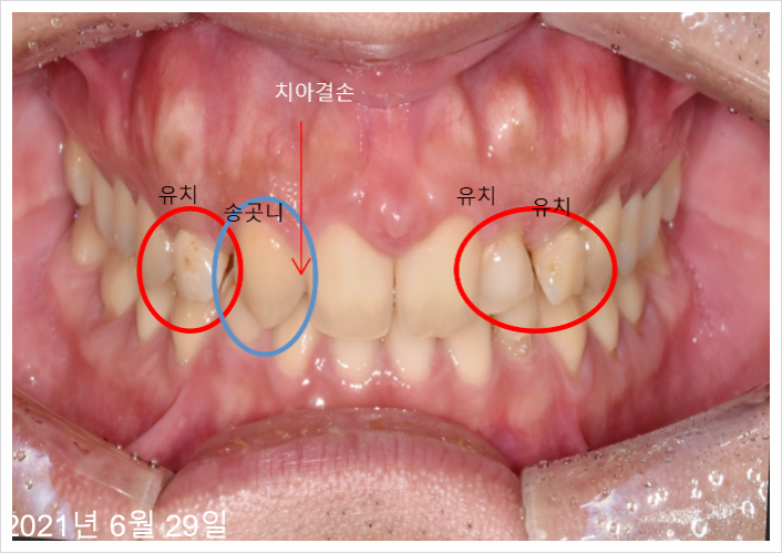 임플란트병원추천, OO모르면 후회한다? 관련 이미지 1