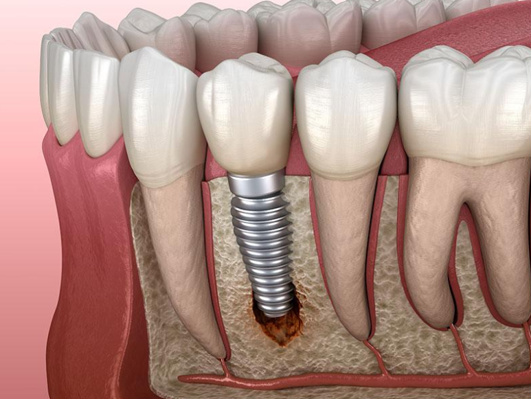 Yeoksam-dong Dental Clinic Implants, Why One Mistake Can Lead to a Lifetime of Regret 〈Written by the Director〉 image 4
