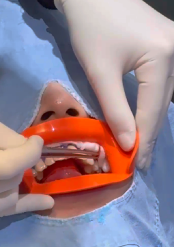 선릉역치아미백 리뷰 보기 전에 관련 이미지 7