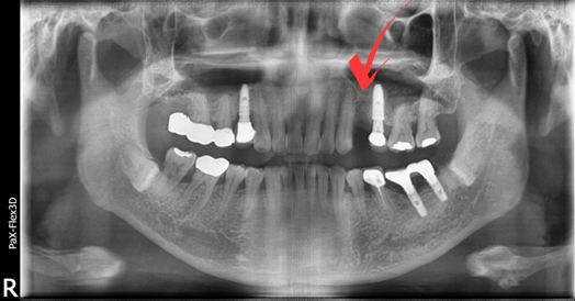 국산임플란트를 선택한 이유, 치료사례 공개합니다 관련 이미지 7