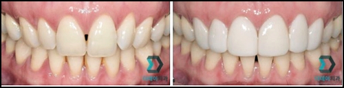 토끼이빨라미네이트? 치과의사가 정확하게 알려드릴게요. 관련 이미지 1