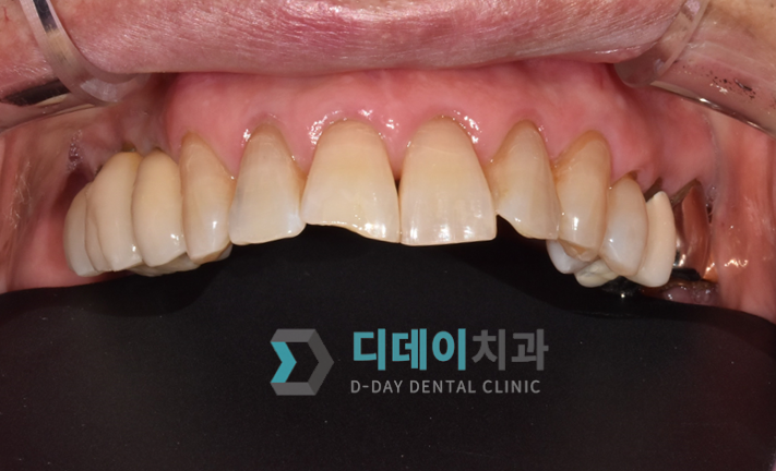 치아성형비용, 비싼 것만은 아닙니다. 관련 이미지 4