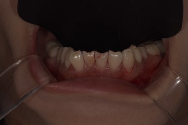 교정없이 라미네이트로 치아배열 개선? 앞니 12개 케이스 공개 관련 이미지 9