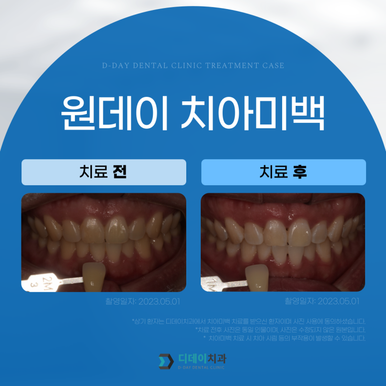 치과치아미백, 700명 이상이 디데이치과를 선택한 이유? 관련 이미지 2