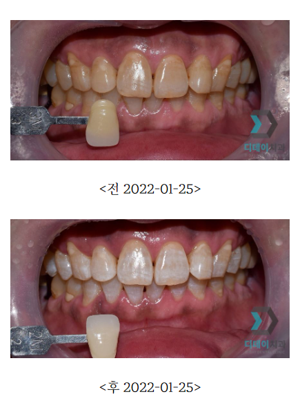 한티역 치아미백 가격부터 전후사진 비교까지 관련 이미지 3