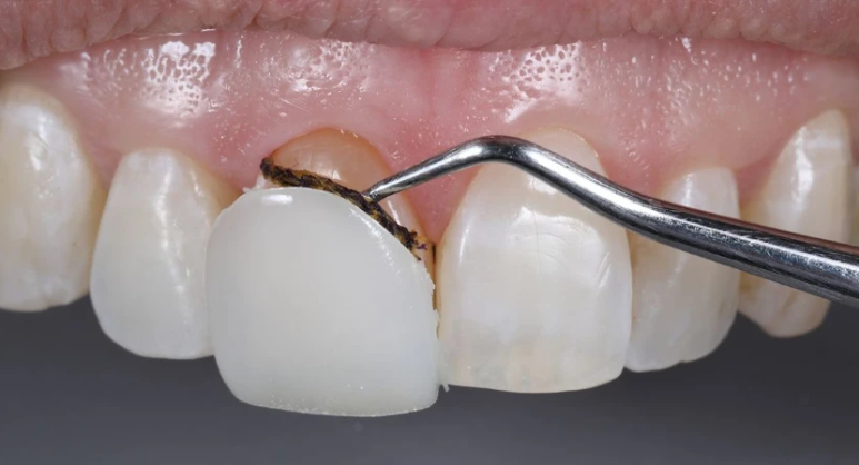 Laminated Veneer Removal: If You Want It Done Safely Without Pain, Check Just One Thing image 2