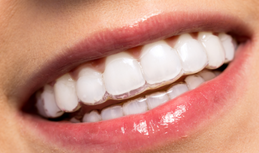 삼성역 치과 투명교정, 일반교정과 뭐가 다른지 정리해드립니다 관련 이미지 9