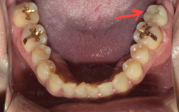 국산임플란트를 선택한 이유, 치료사례 공개합니다 관련 이미지 5