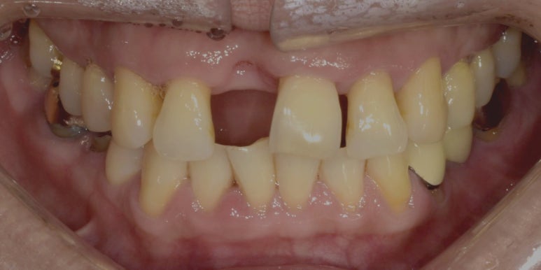 앞니브릿지, 임플란트와의 차이점과 가격까지 비교분석 관련 이미지 4