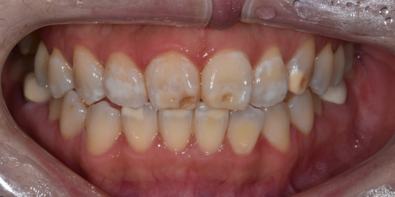 라미네이트 전후 비교, 주의사항, 비용까지 총정리 관련 이미지 11