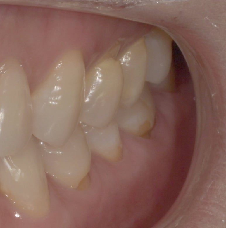 치아파임으로 이가 시리다면? 치경부마모증 치료방법과 비용 알고가기 관련 이미지 5
