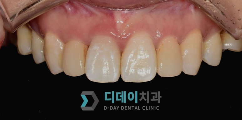 라미네이트재시술?00부터 확인하세요. 관련 이미지 3