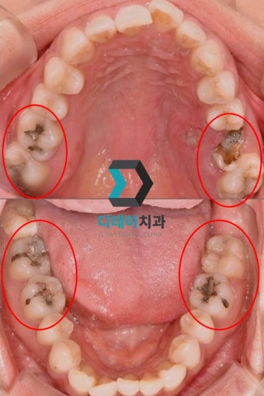 충치파절증상 초기에 발견하면 간단하게 치료됩니다 관련 이미지 6