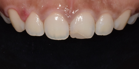 치은절제술/성형술? 잇몸이 치아를 덮고 있어 고민인 분만 관련 이미지 6