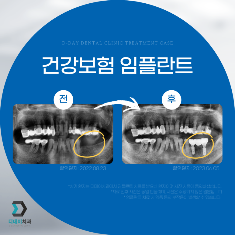 임플란트종류, 브랜드별로 무슨 차이인지 뭐가 좋은지 모르겠다면? 관련 이미지 2