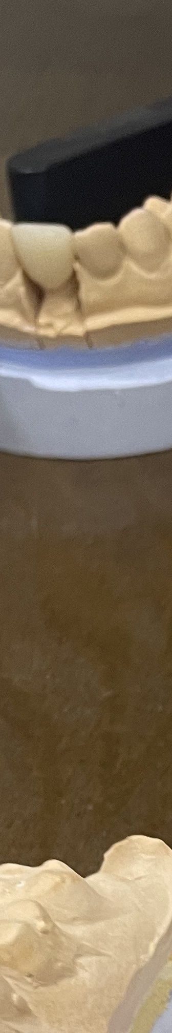 매봉역 치과, 자연치아 잃고 싶지 않다면? 관련 이미지 7