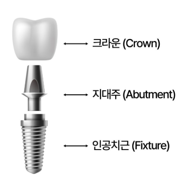 임플란트구조, 의사가 알려주는 2가지 핵심 구성요소 관련 이미지 9