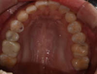 임플란트평생 사용 가능할까? 현직자가 공개합니다. 관련 이미지 3