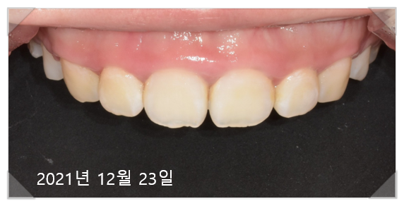 잇몸수술비용? 이 글로 종결합니다. 관련 이미지 9