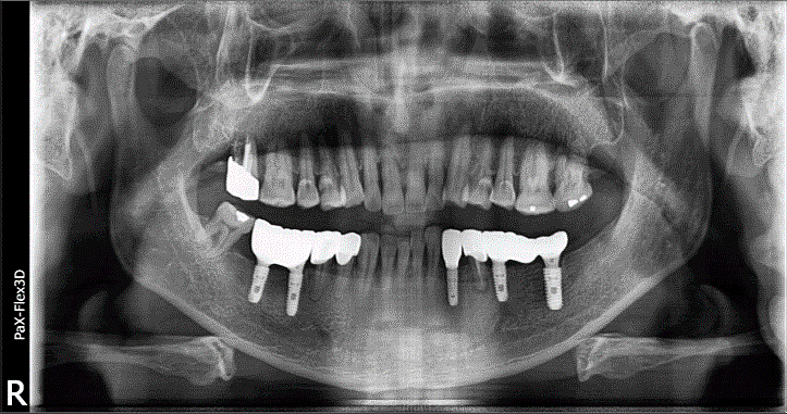 상악동 거상술 비용, 통증까지 치과의사가 알려드립니다 관련 이미지 2