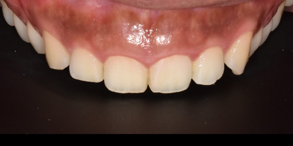 잇몸절제? 절개없이 레이저로 잇몸성형한 후기 관련 이미지 8