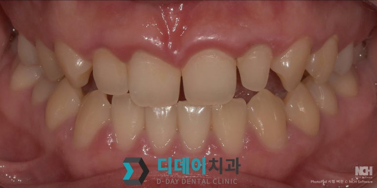 라미네이트 비용 차이나는 이유 의사가 직접 설명합니다 관련 이미지 7