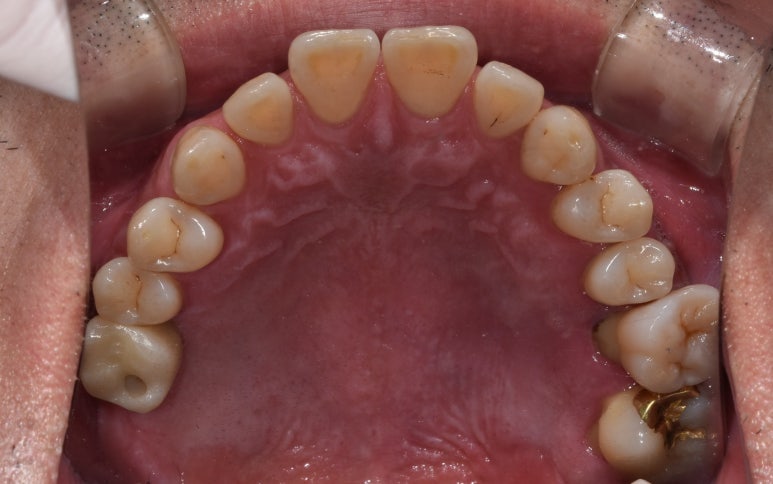 상악동거상술과 뼈이식임플란트 실제 치료사례로 보여드립니다. 관련 이미지 8