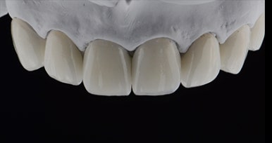 Laminated Veneer Removal: If You Want It Done Safely Without Pain, Check Just One Thing image 4