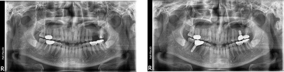 임플란트가격, 적절한 비용은 얼마? 관련 이미지 4
