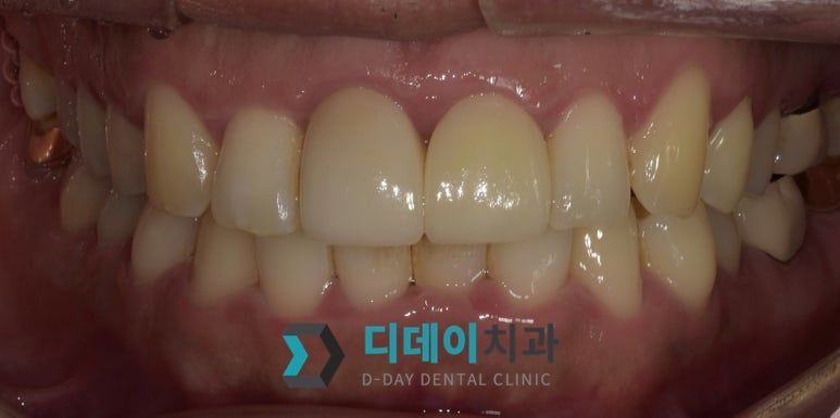 강남 올세라믹 지르코니아 어떤 보철물이 좋을까요? 관련 이미지 4