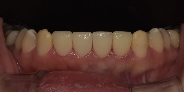 아랫니라미네이트, 잘하는 치과 찾는 2가지 기준 의사 작성 관련 이미지 4
