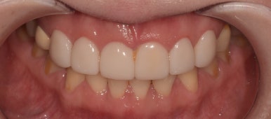 [진심인터뷰] 1n년 고민한 라미네이트, 디데이치과에서 만족도 200%인 이유? ① 관련 이미지 2