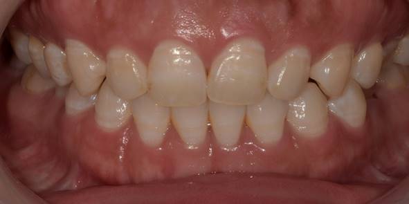 잇몸성형후기, 사례가 없어 고민하셨던 분만 관련 이미지 11