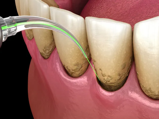 강남 치주잇몸소파술 치과, 손해 보기 싫다면? 관련 이미지 6